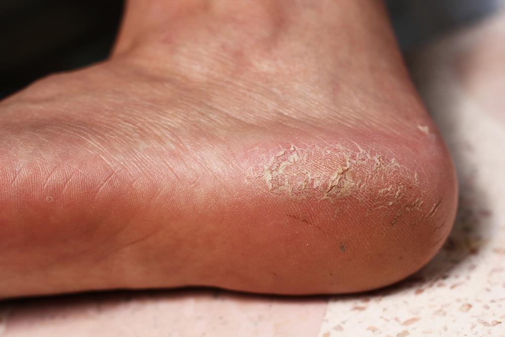 Calluses Anaheim, CA